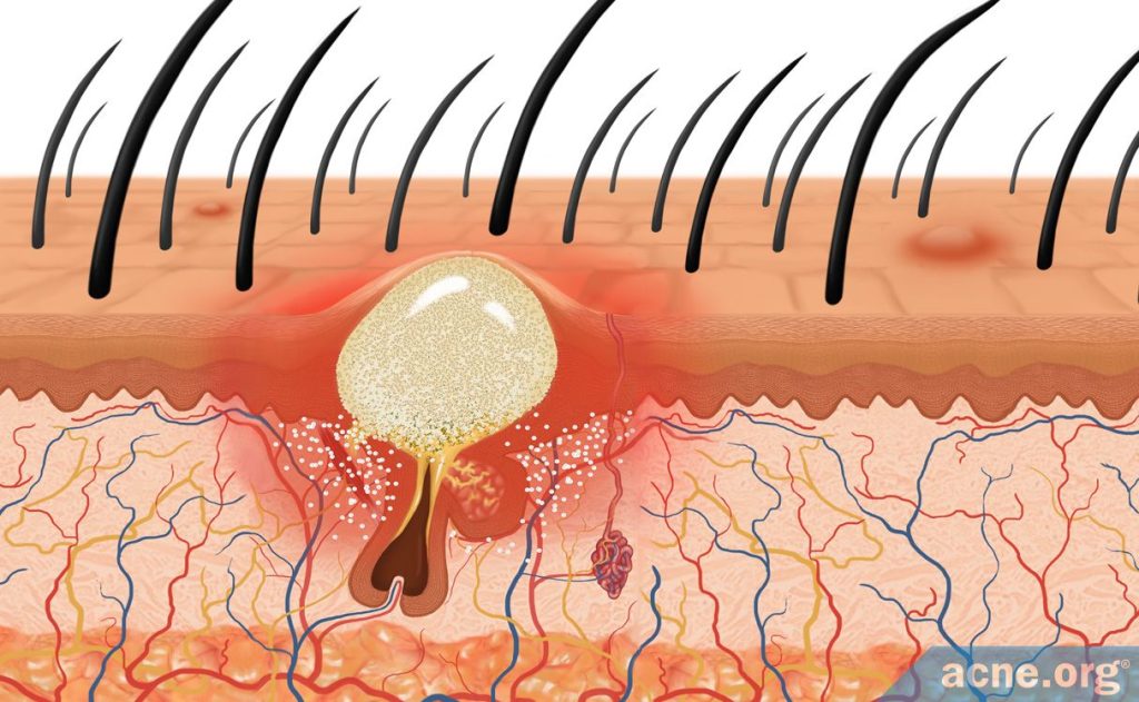 causes of scalp pimples